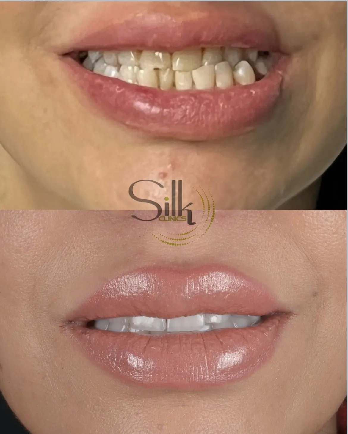 Porcelain veneers before and after smile transformation at Silk Clinics Dubai — dental-smile-transformation-veneers-2