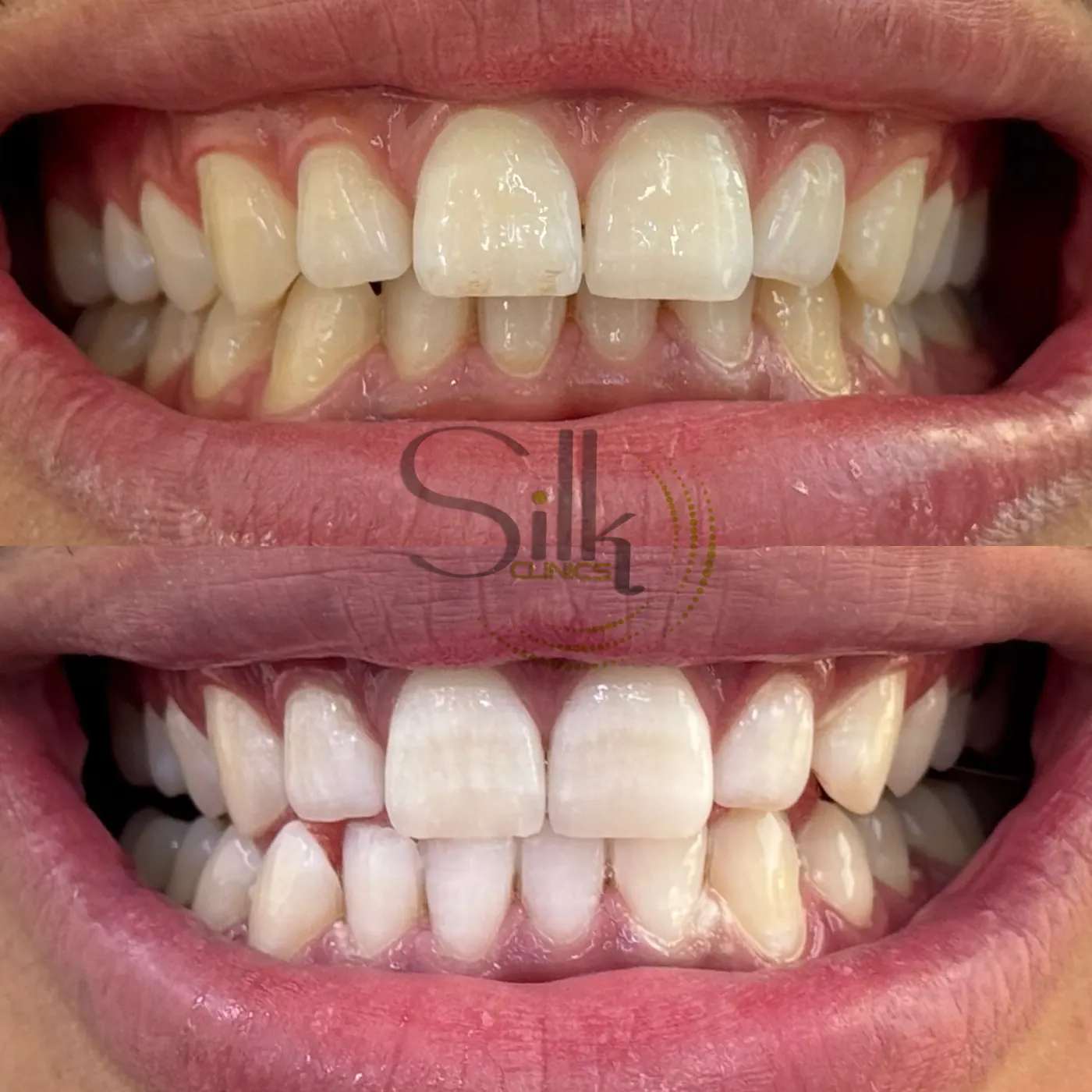 Teeth whitening before and after — professional in-clinic Hollywood Smile brightening in Dubai at Silk Clinics