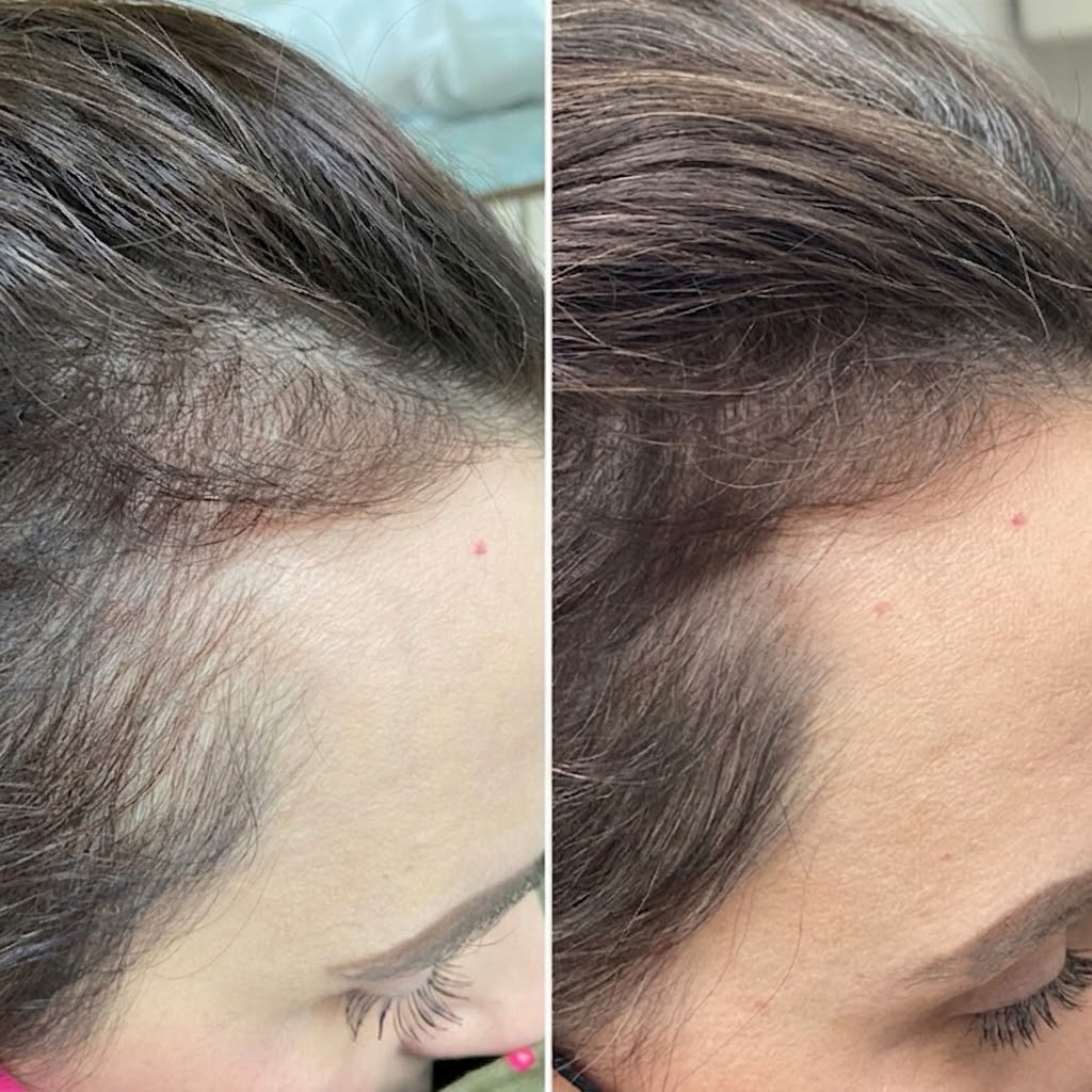 PRP and biotin hair treatment before and after — female part-line thickening in Dubai at Silk Clinics
