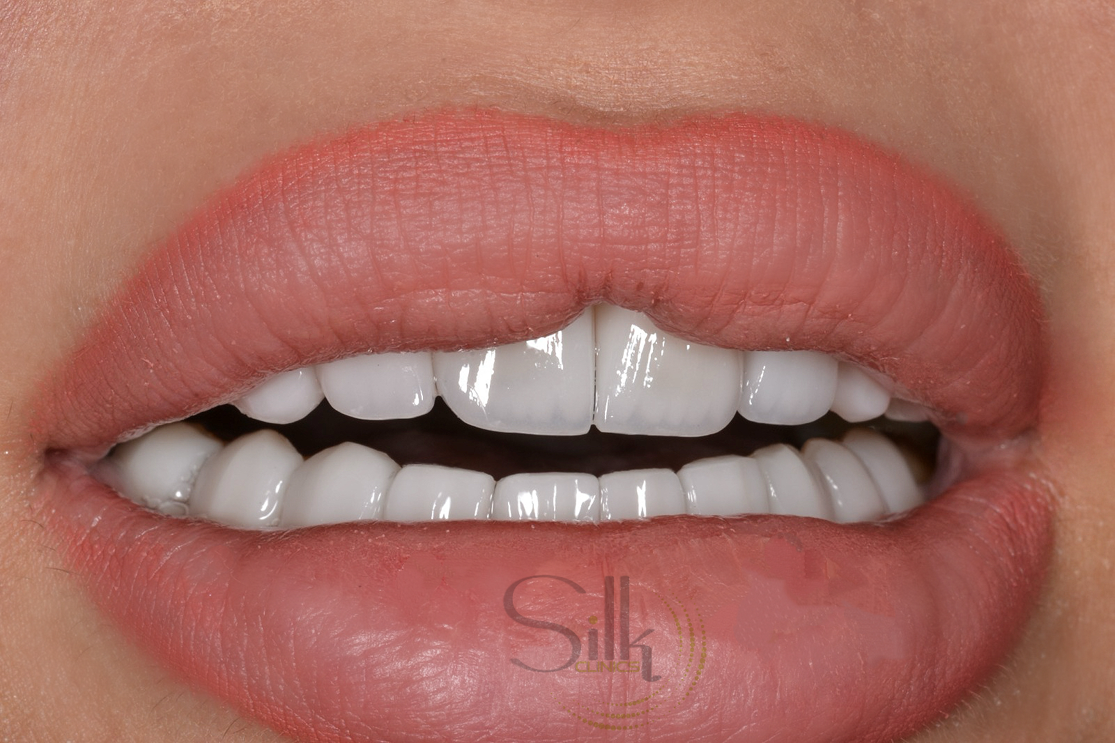 Porcelain veneer smile with symmetric anterior six in Dubai — Silk Clinics