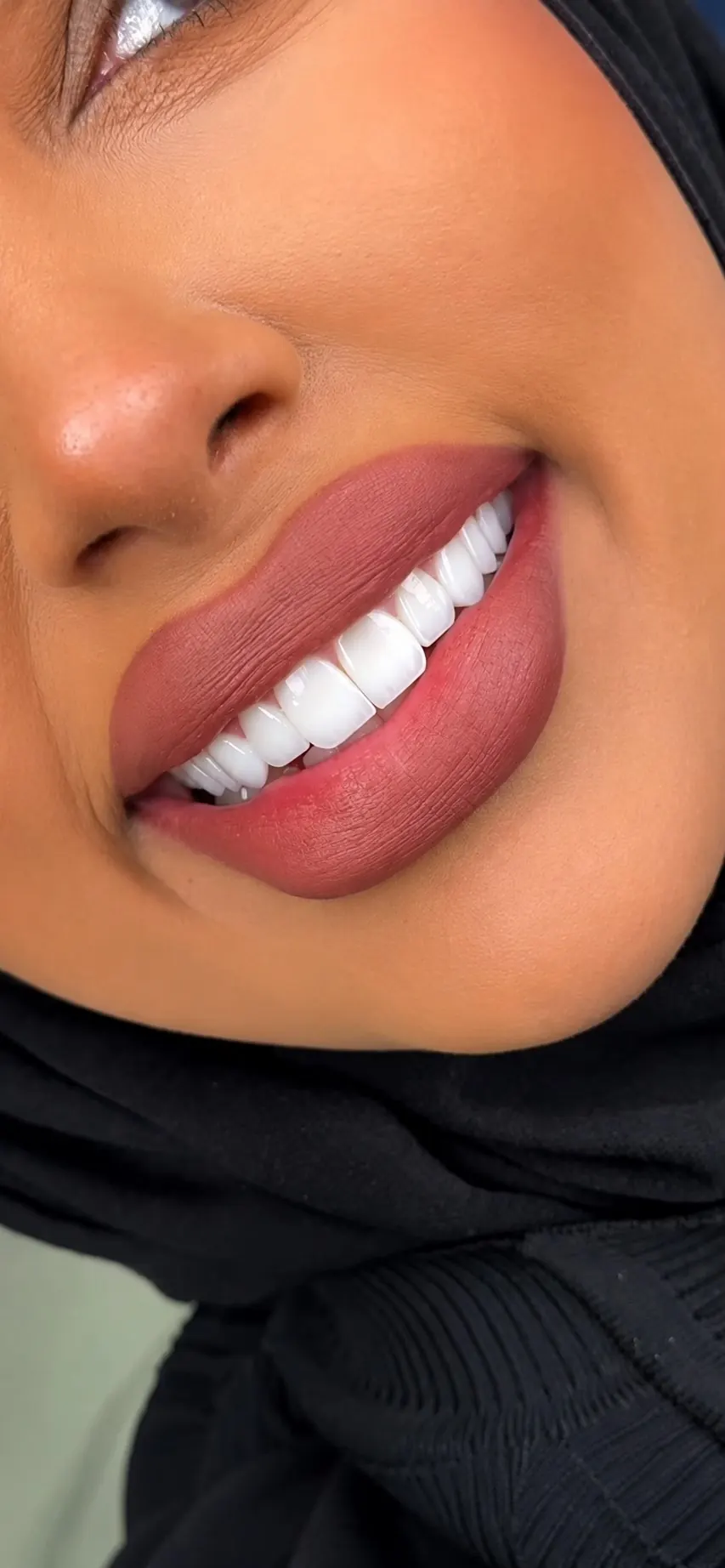 Hollywood Smile veneers portrait result in Dubai — Silk Clinics
