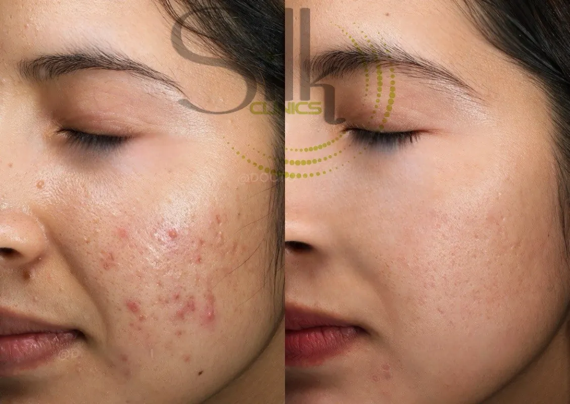 Active acne and post-inflammatory hyperpigmentation before and after — chemical peel and PRP in Dubai at Silk Clinics