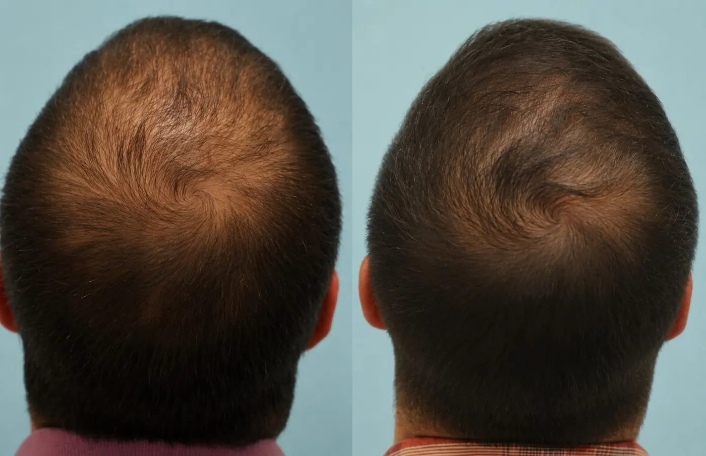 PRP and exosome hair treatment before and after — male crown bald spot regrowth in Dubai at Silk Clinics