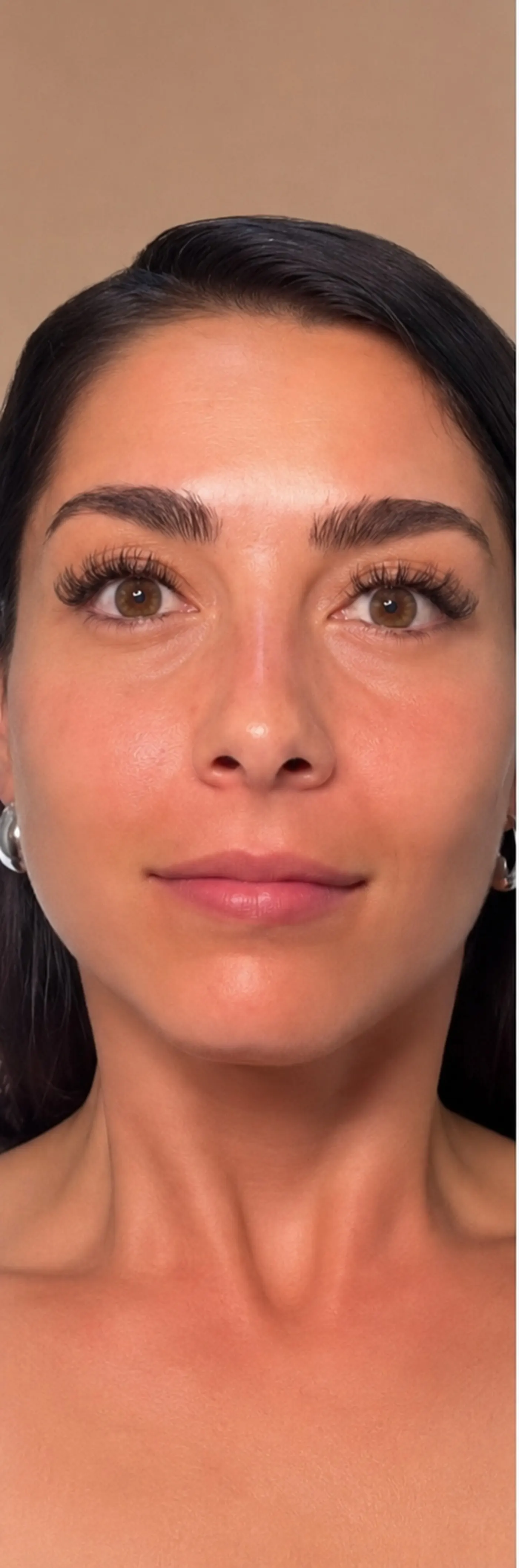 After Botox forehead lines treatment at Silk Clinics Dubai — smoother forehead with natural brow position preserved.