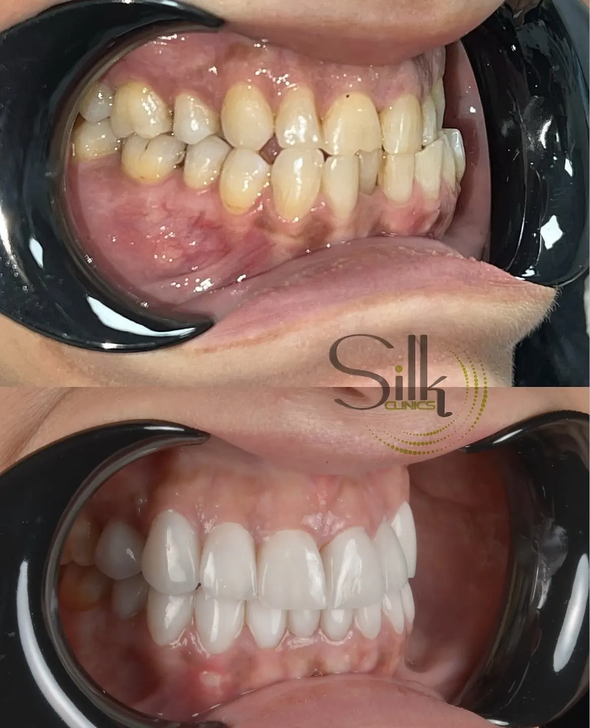 Porcelain veneers before and after smile transformation at Silk Clinics Dubai — dental-hollywood-smile-full-arch-veneers