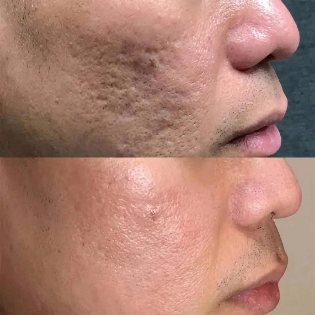 Deep atrophic acne scars before and after — CO2 laser and Scarlet RF resurfacing in Dubai at Silk Clinics