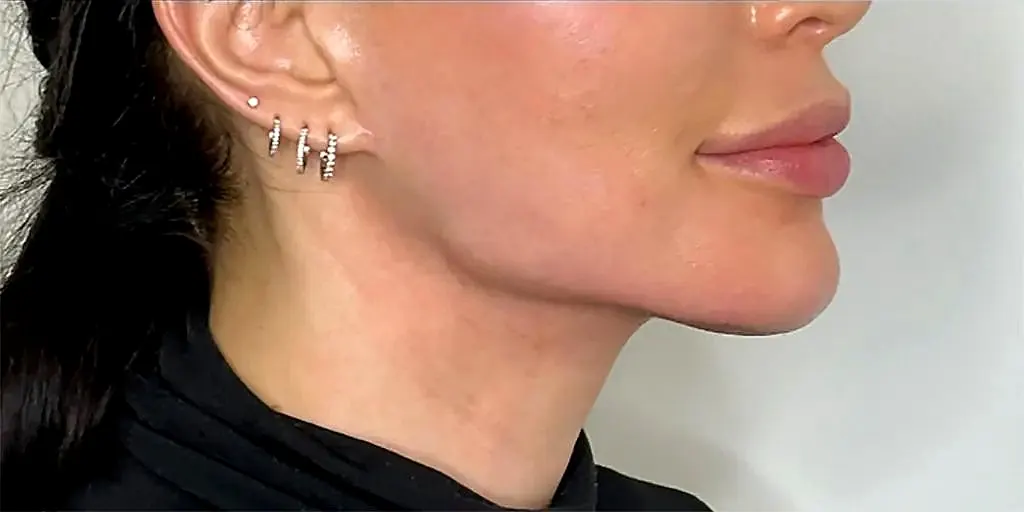 Texas Jawline filler after photo at Silk Clinics Dubai — sharper mandibular angle, improved chin projection and refined jaw-to-neck transition.