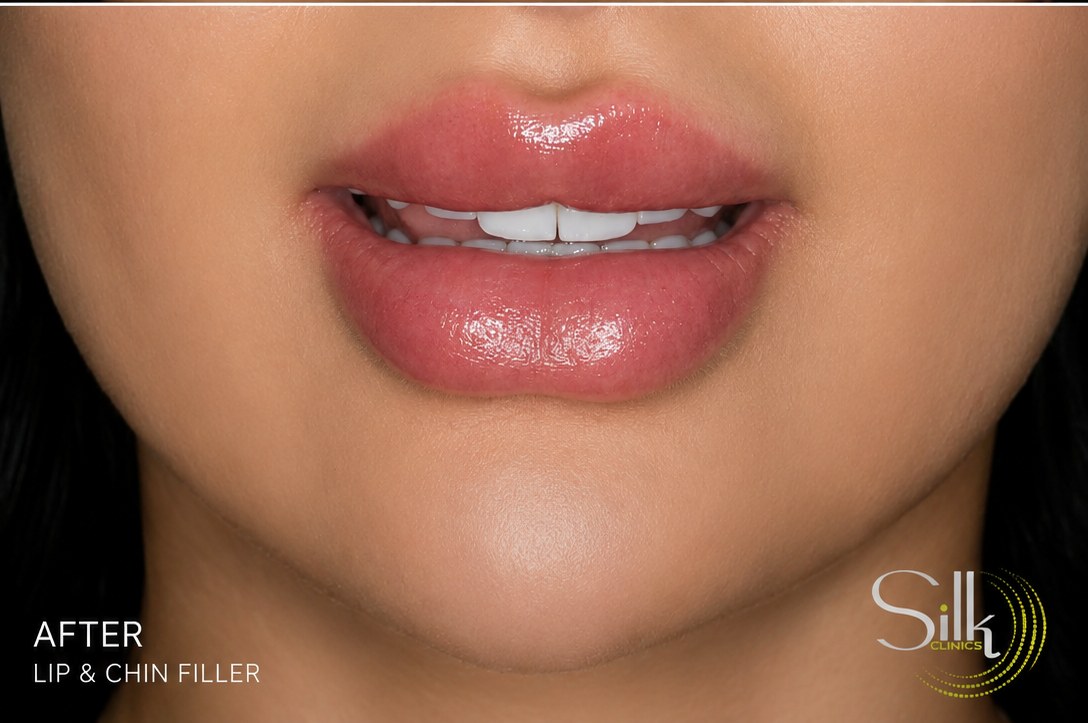 Lip and chin filler before and after results showing improved facial balance, lip volume and chin definition at Silk Clinics Dubai.