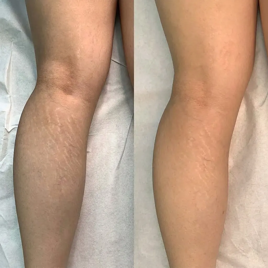 Stretch marks before and after — knee and leg treatment with Scarlet RF, exosomes, growth factors, PRP and mesotherapy in Dubai at Silk Clinics