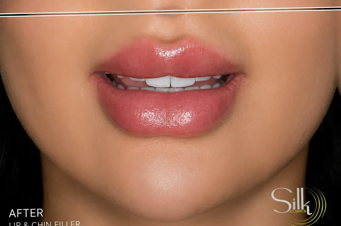Lip and chin filler before and after results showing improved facial balance, lip volume and chin definition at Silk Clinics Dubai.