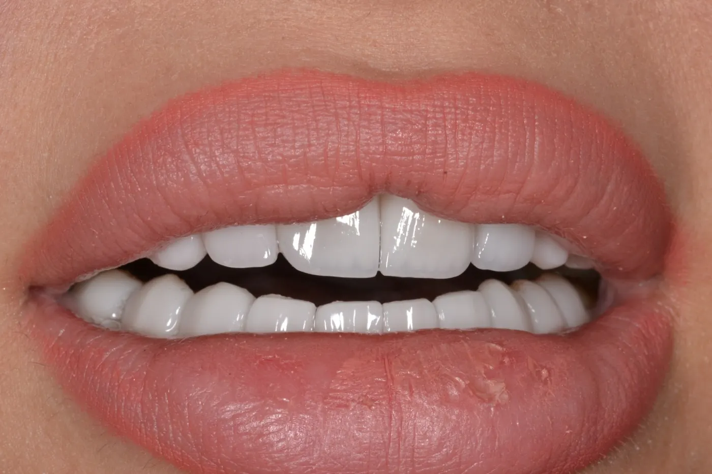 Hollywood Smile Emax veneers in bright shade in Dubai — Silk Clinics