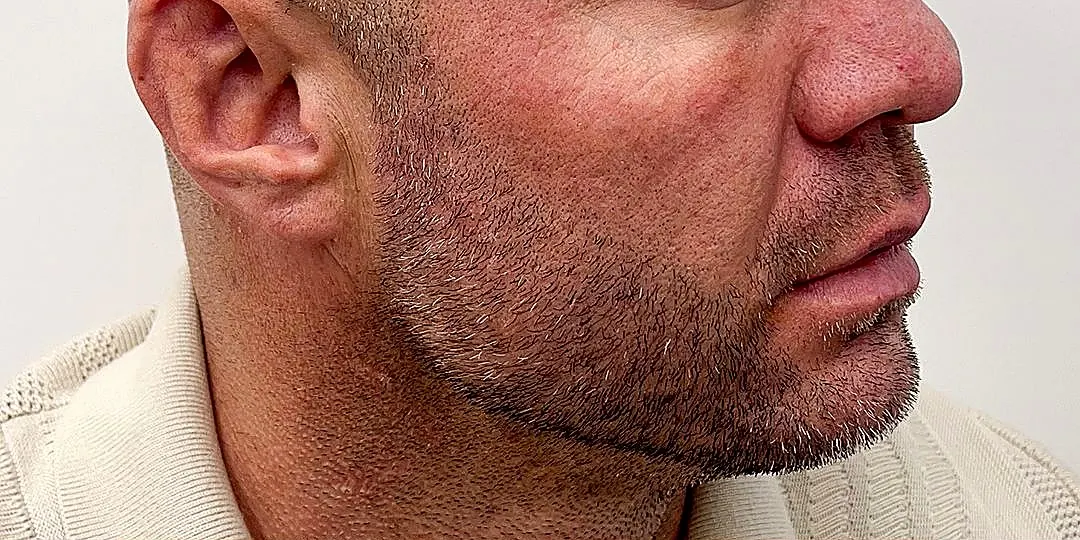 Male jawline filler before photo at Silk Clinics Dubai — patient profile showing undefined mandibular angle and weak chin projection.