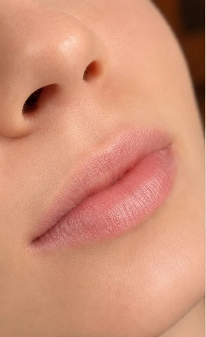 Lip filler before and after results at Silk Clinics Dubai — natural lip enhancement showing improved volume and border definition.