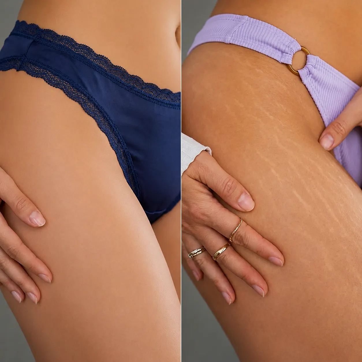 Stretch marks before and after — thigh treatment with Scarlet RF, CO2 laser, chemical peel, microneedling, exosomes, growth factors, PRP and mesotherapy in Dubai at Silk Clinics