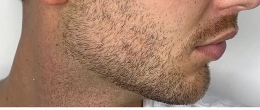 Male chin and jawline filler before photo at Silk Clinics Dubai — side profile showing weak chin projection and undefined lower jawline.