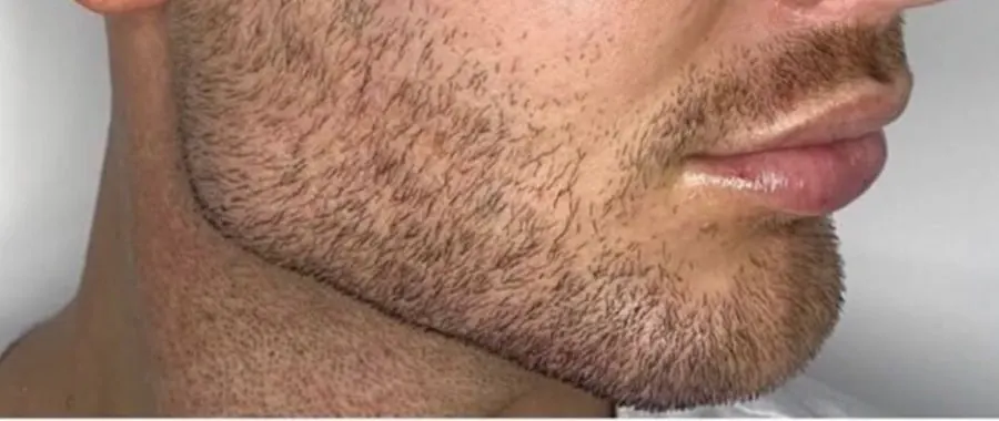 Male chin and jawline filler after photo at Silk Clinics Dubai — sharper chin projection and defined jaw-to-neck line after Texas Jawline treatment.