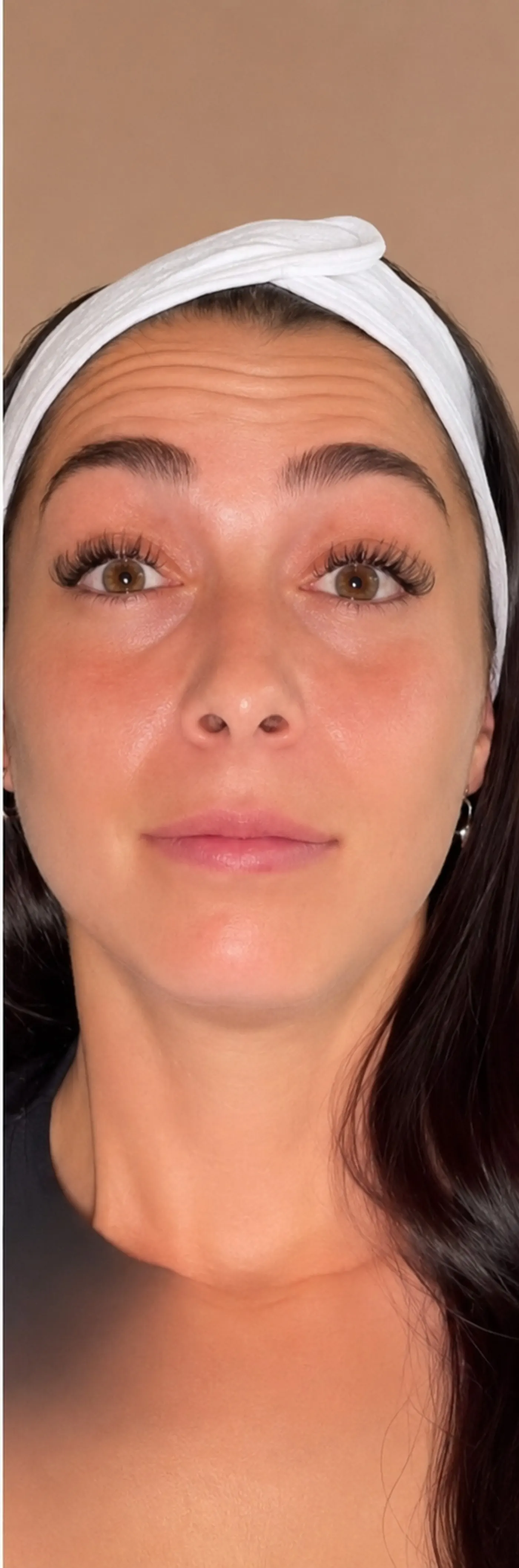 Before Botox forehead lines treatment at Silk Clinics Dubai — patient at rest showing horizontal forehead wrinkles.