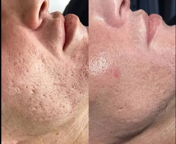 Acne scar treatment before and after — chin Scarlet RF + PRP + mesotherapy in Dubai at Silk Clinics
