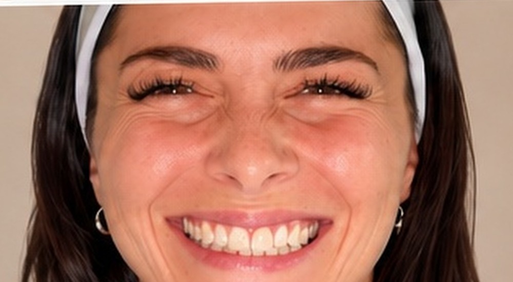 Before Botox crow's feet treatment at Silk Clinics Dubai — patient smiling with prominent dynamic lines around the eyes.