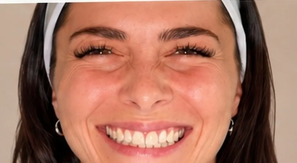 Before Botox crow's feet treatment at Silk Clinics Dubai — patient smiling with prominent dynamic lines around the eyes.