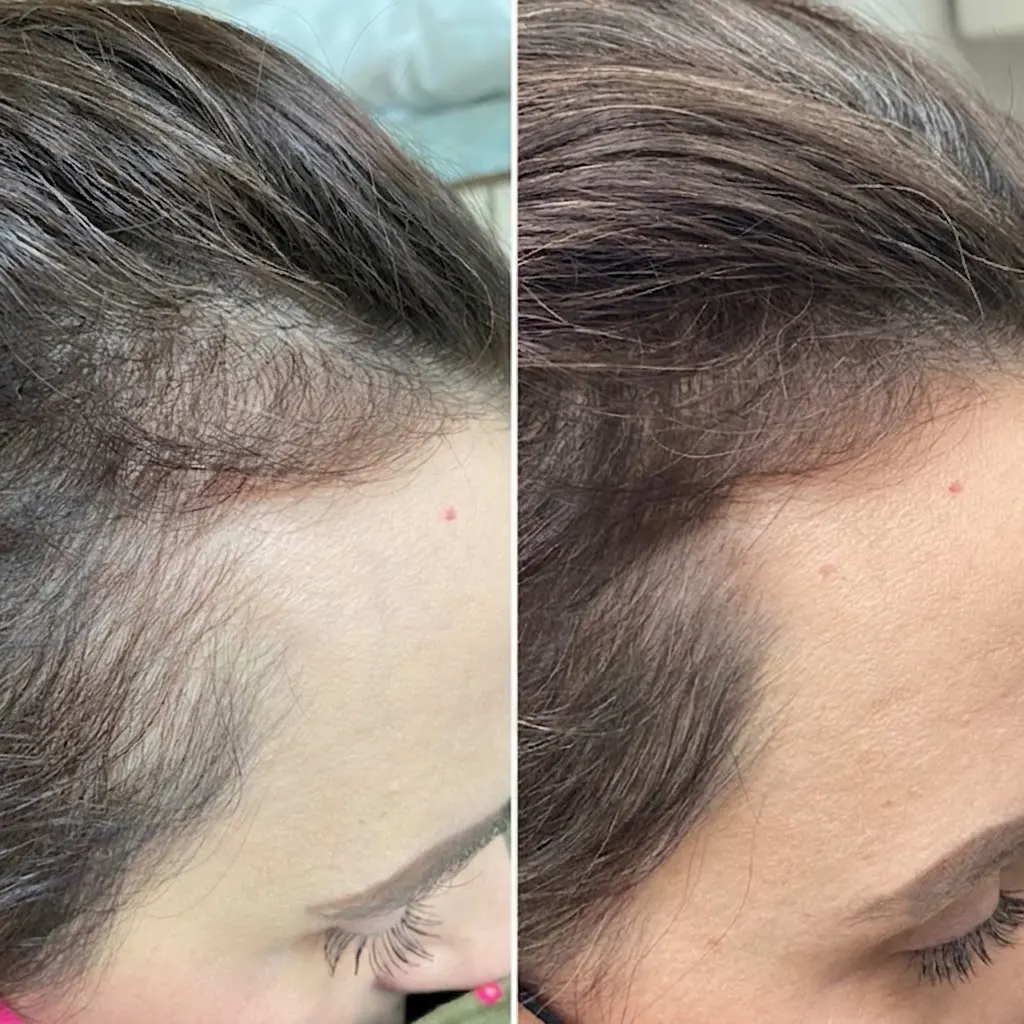 PRP and biotin hair treatment before and after — female part-line thickening in Dubai at Silk Clinics