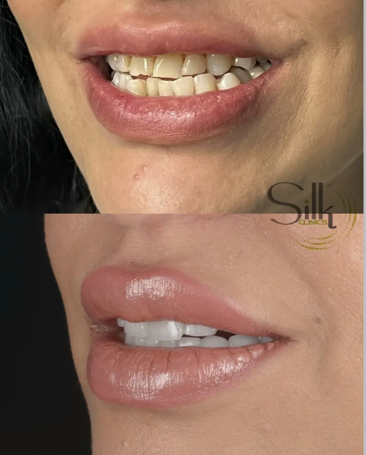Porcelain veneers before and after smile transformation at Silk Clinics Dubai — dental-smile-transformation-veneers-1