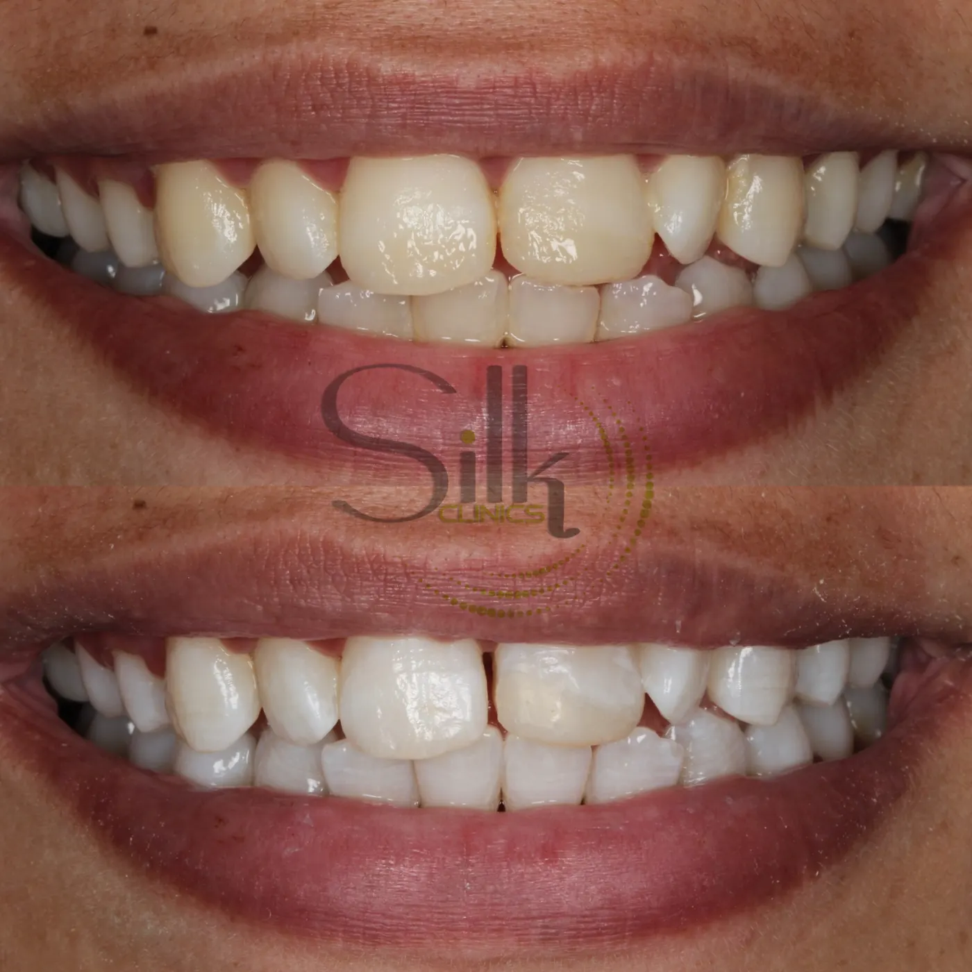 Teeth whitening before and after — Hollywood Smile enamel brightening result in Dubai at Silk Clinics