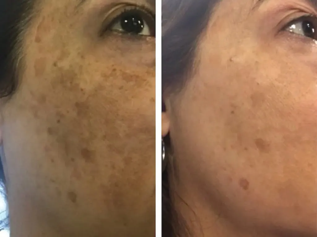 Melasma before and after — CO2, chemical peel and mesotherapy for cheek pigmentation in Dubai at Silk Clinics