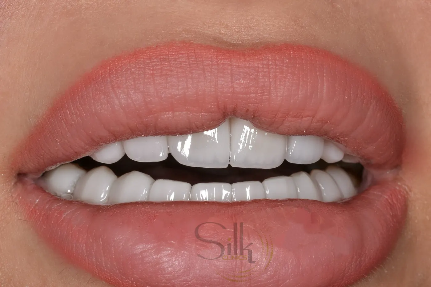 Porcelain veneer smile with symmetric anterior six in Dubai — Silk Clinics