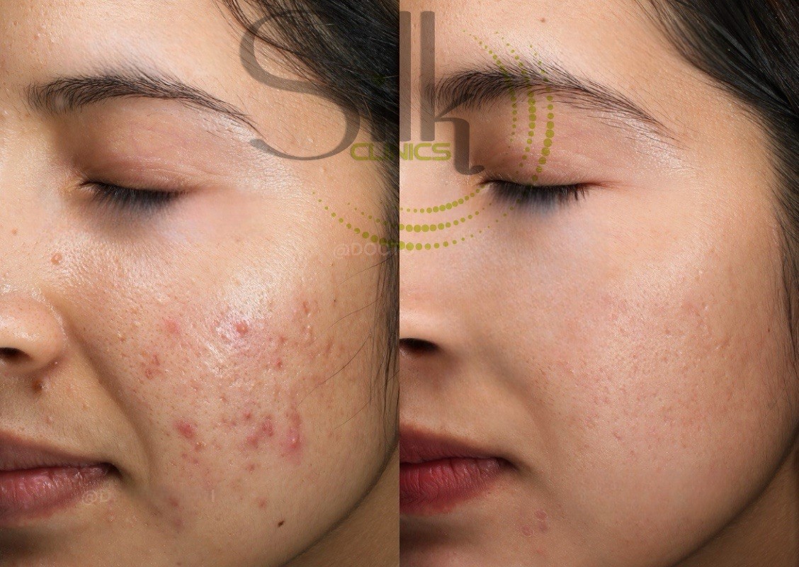 Active acne and post-inflammatory hyperpigmentation before and after — chemical peel and PRP in Dubai at Silk Clinics