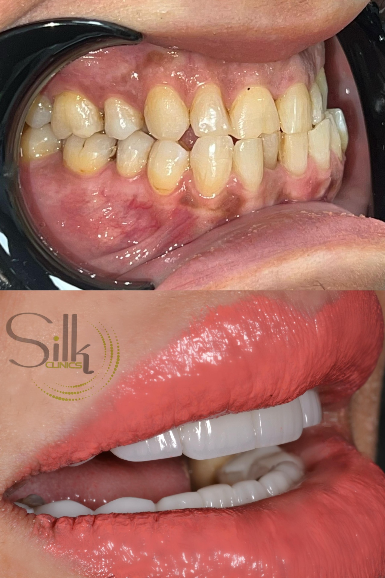 Porcelain veneers before and after smile transformation at Silk Clinics Dubai — dental-veneers-natural-shade-match