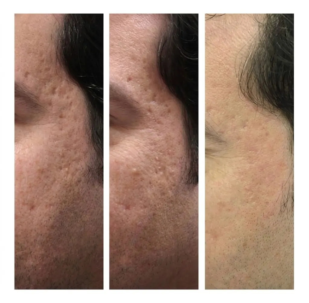Acne scar treatment progression — 3-stage CO2 laser, Scarlet RF, peel and PRP course in Dubai at Silk Clinics
