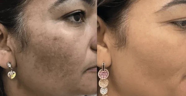 Facial melasma before and after — combined CO2, peel, PRP and mesotherapy protocol in Dubai at Silk Clinics