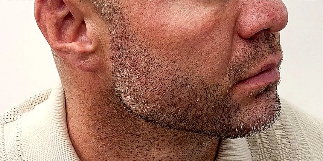 Male jawline filler after photo at Silk Clinics Dubai — sharper mandibular angle and stronger chin projection following Texas Jawline treatment.