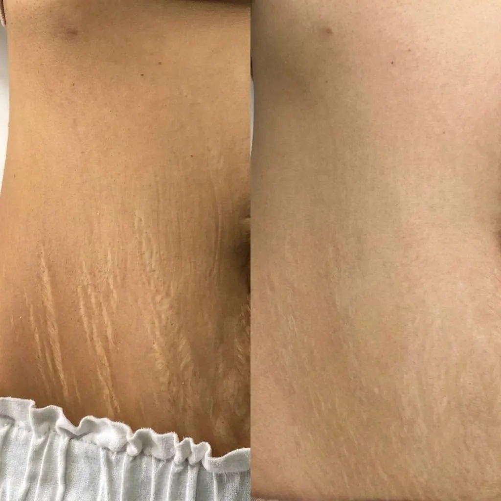 Post-pregnancy abdominal stretch marks before and after — microneedling, PRP, exosomes and growth factors in Dubai at Silk Clinics
