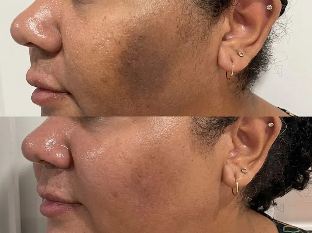Jawline hyperpigmentation before and after — CO2, chemical peel and mesotherapy in Dubai at Silk Clinics