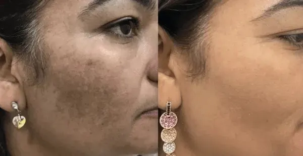 Facial melasma before and after — combined CO2, peel, PRP and mesotherapy protocol in Dubai at Silk Clinics