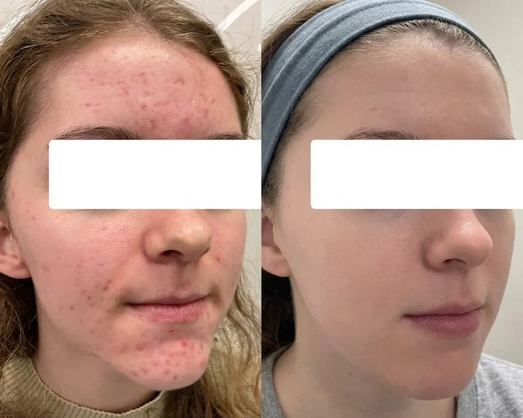 Active acne treatment before and after — chemical peel and PRP for female forehead and cheek acne in Dubai at Silk Clinics