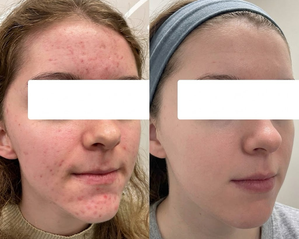 Active acne treatment before and after — chemical peel and PRP for female forehead and cheek acne in Dubai at Silk Clinics