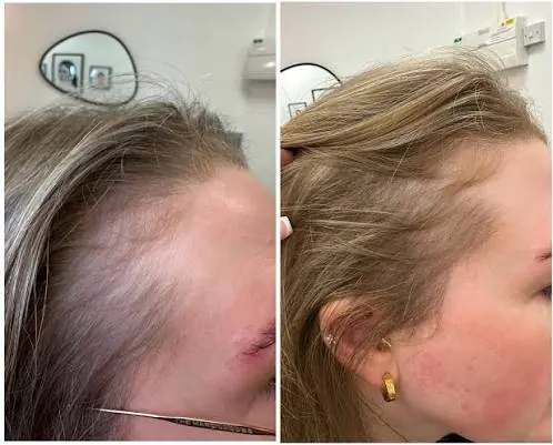 Exosome and growth-factor hair treatment before and after — female hairline regrowth in Dubai at Silk Clinics