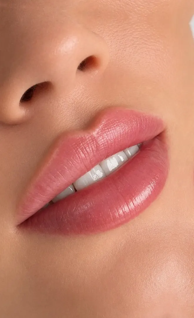 Natural lip filler before and after results showing enhanced lip volume and improved border definition at Silk Clinics Dubai.
