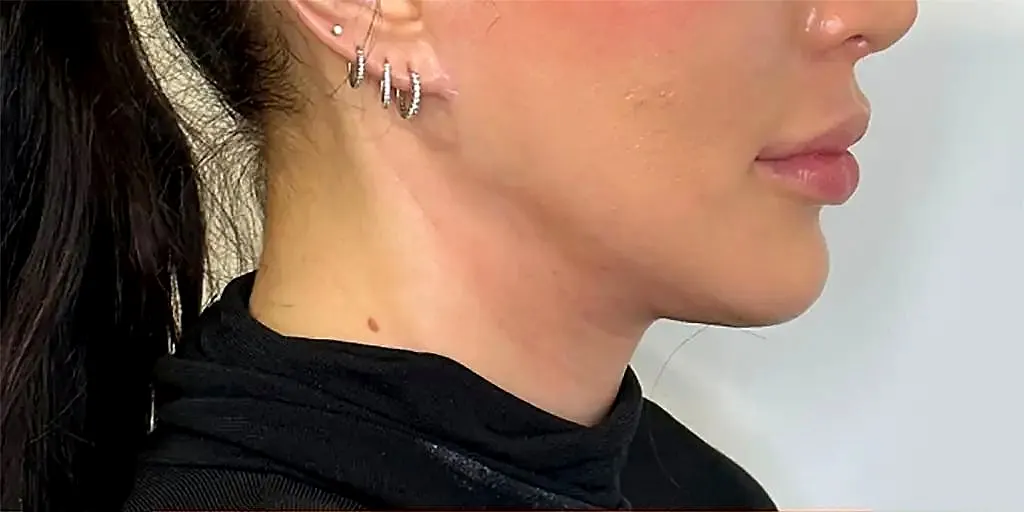 Texas Jawline filler before photo at Silk Clinics Dubai — female patient profile showing soft jawline angle and recessed chin before treatment.