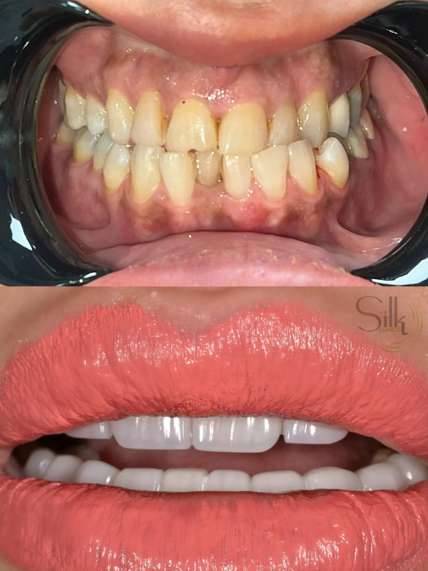 Porcelain veneers before and after smile transformation at Silk Clinics Dubai — dental-smile-makeover-lower-arch-veneers
